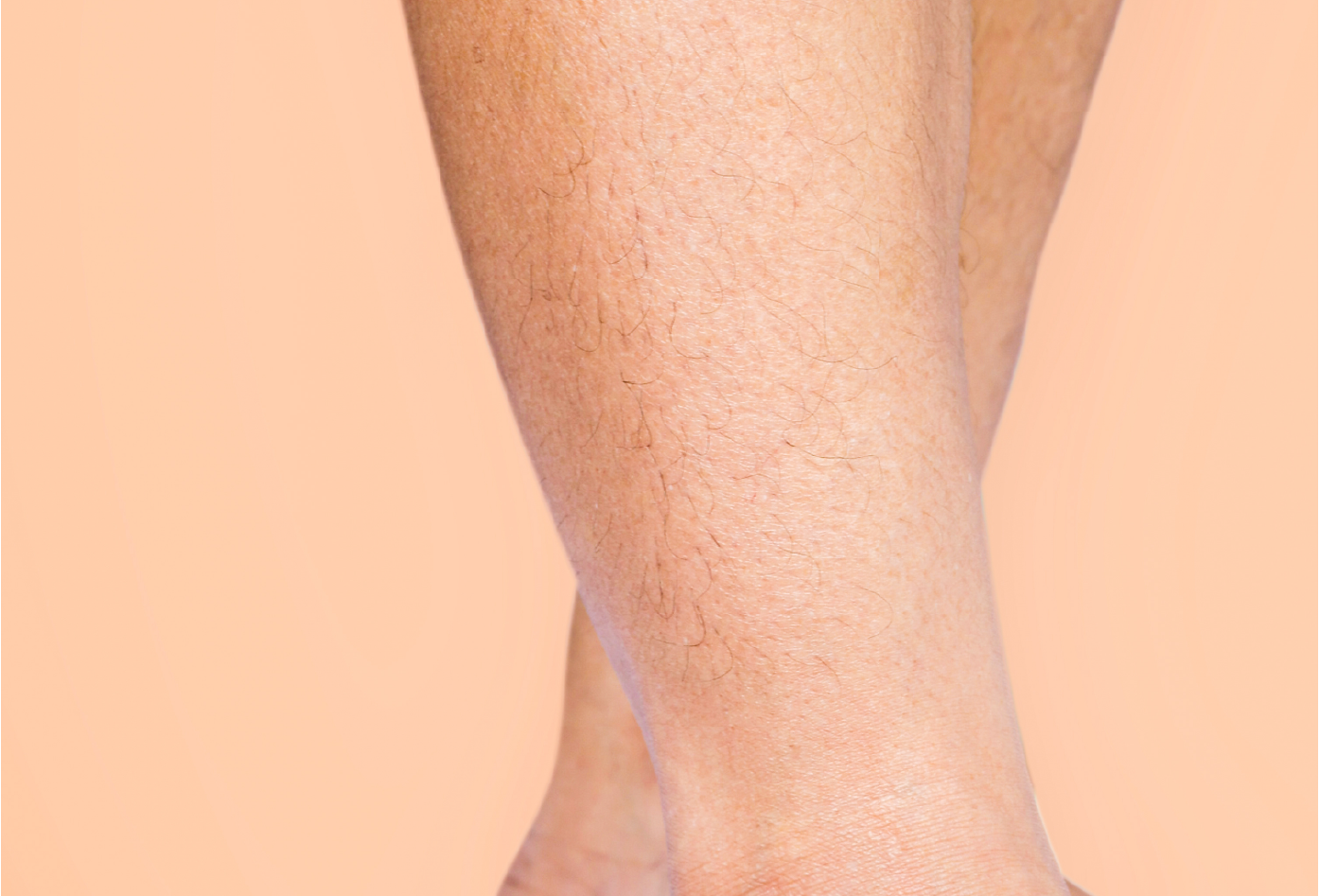 Résultats visibles d'une épilation définitive sur les jambes après plusieurs séances avec les appareils LSWS. Peau nette et sans poils